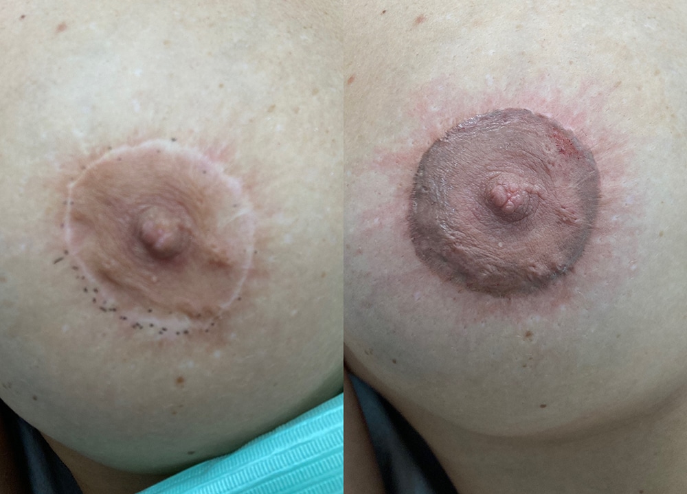 w_areola_Compo1 Cicatrices pecho