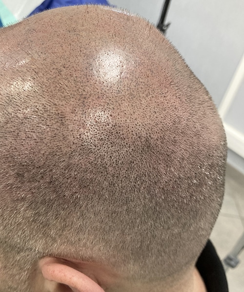 w_capilar Micro capilar