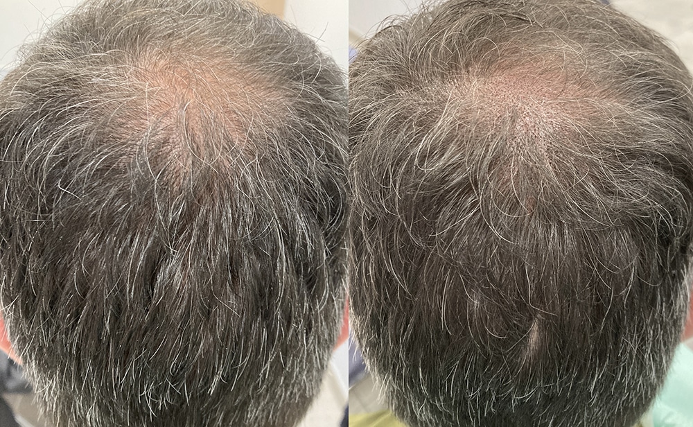 wcapilar1_abans_sessio1_retocat Micro capilar